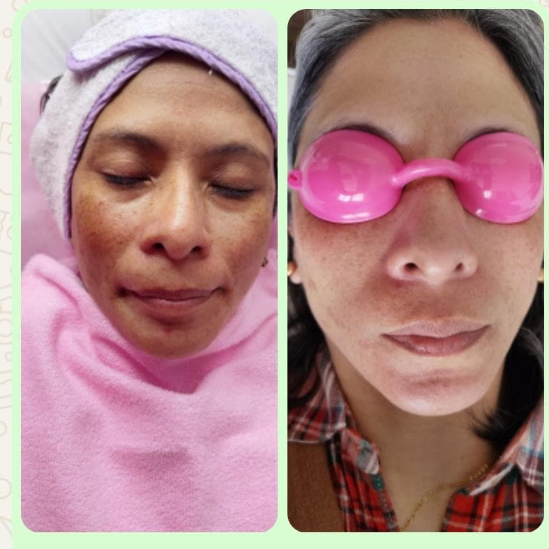 Proceso visual de tratamiento despigmentante